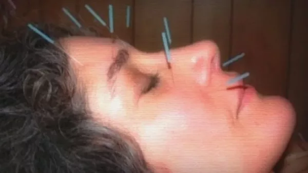 Acupuntura